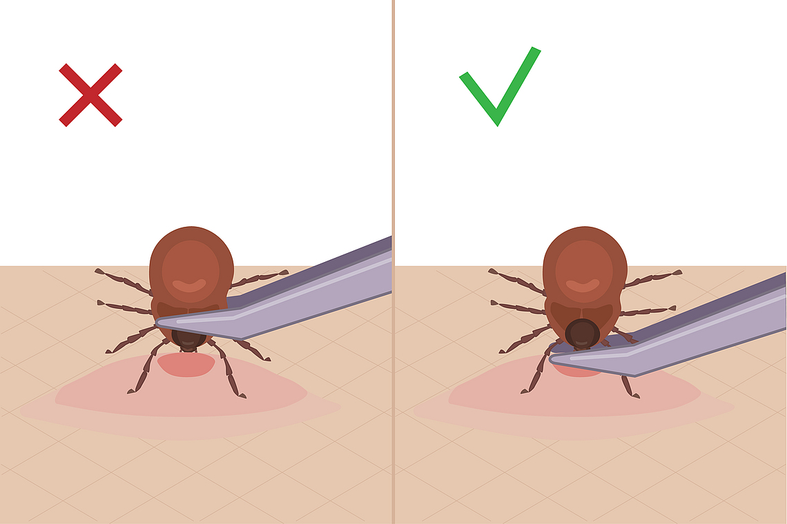 Zwei Grafiken zeigen erstens das falsche und zweitens das richtige Entfernen einer Zecke mit einer Pinzette.
