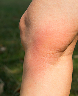 Auf einem Knie gibt es einen geröteten und geschwollenen Fleck nach einem Insektenstich. 